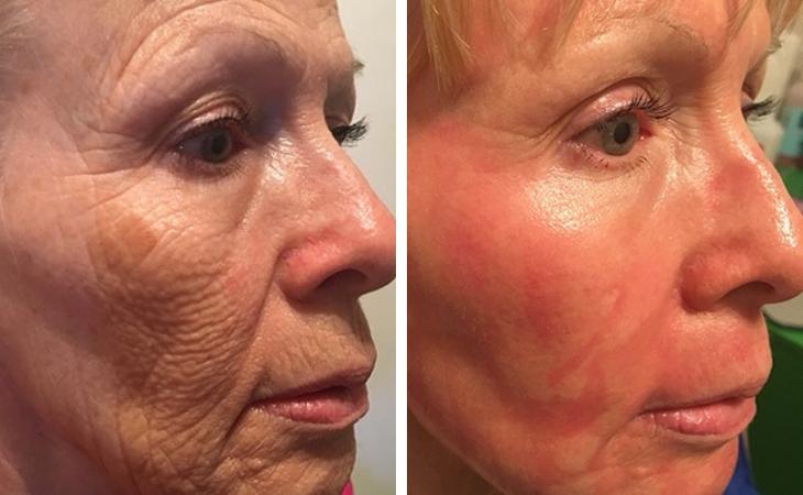 CO2 laser skin resurfacing โ visible texture and tone improvement